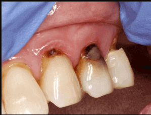 علاج جذور الأسنان المتعفنة